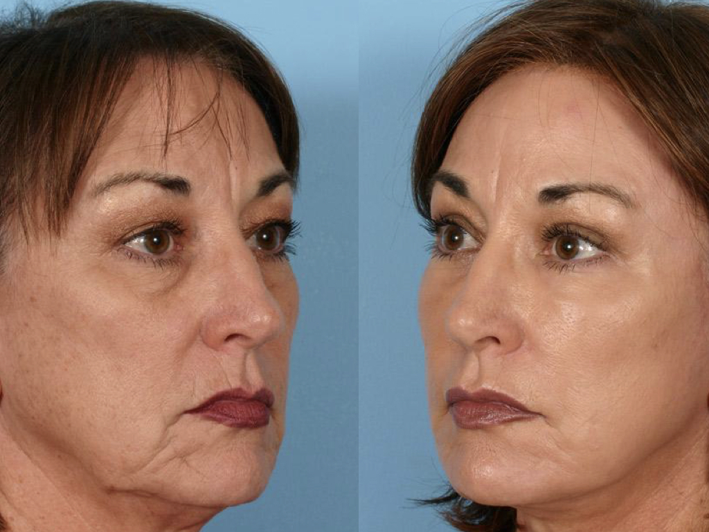 resultados lifting, blefaroplastia y código de barras