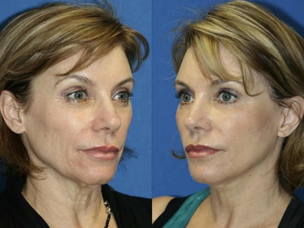 REJUVENECIMIENTO FACIAL