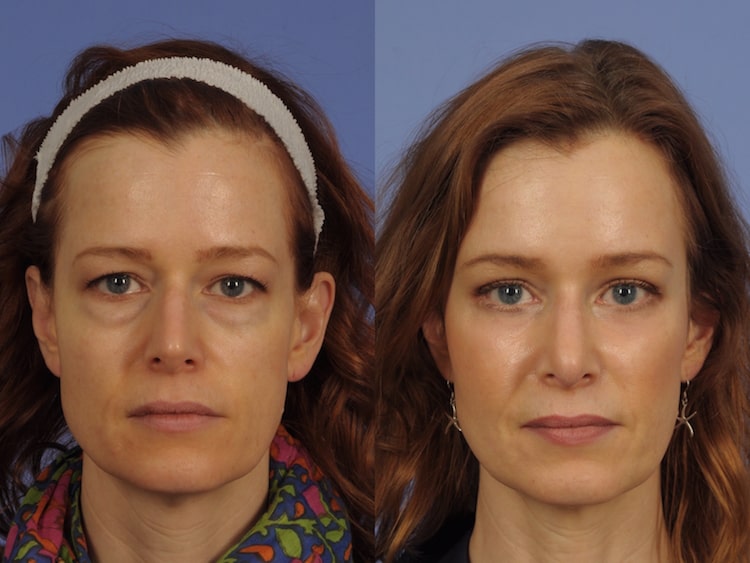 BLEFAROPLASTIA