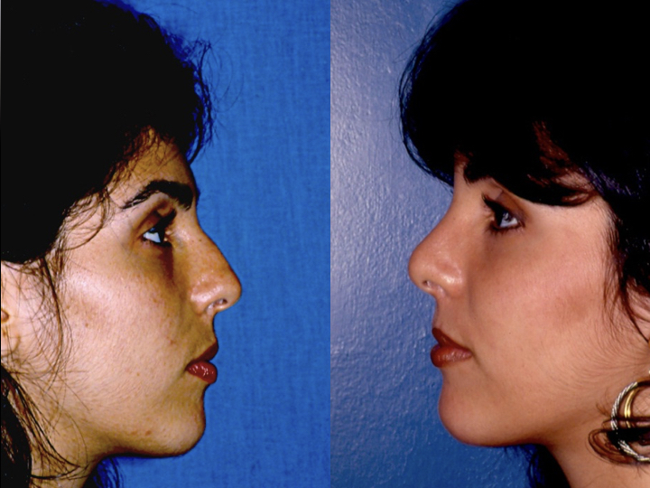 antes y después rinoplastia