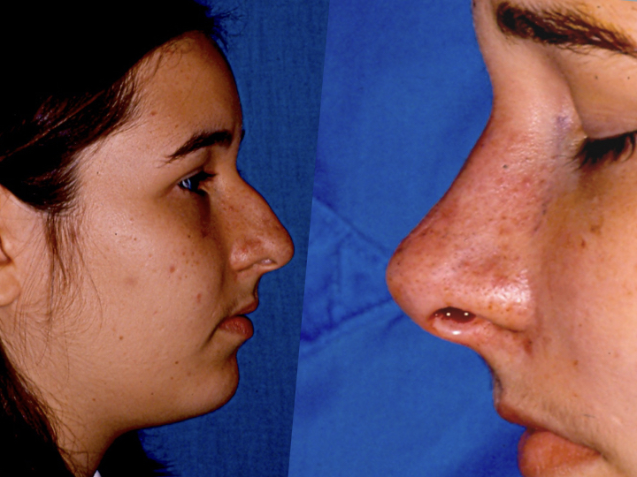 antes y después rinoplastia o cirugía de nariz