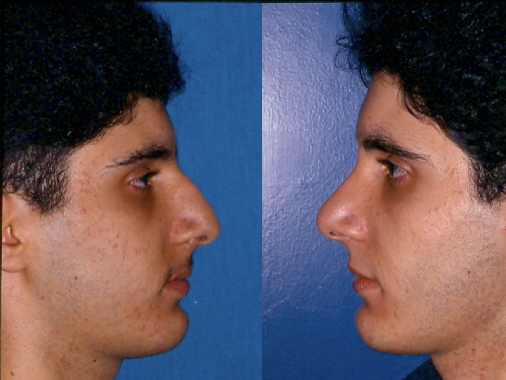 antes y después rinoplastia hombre