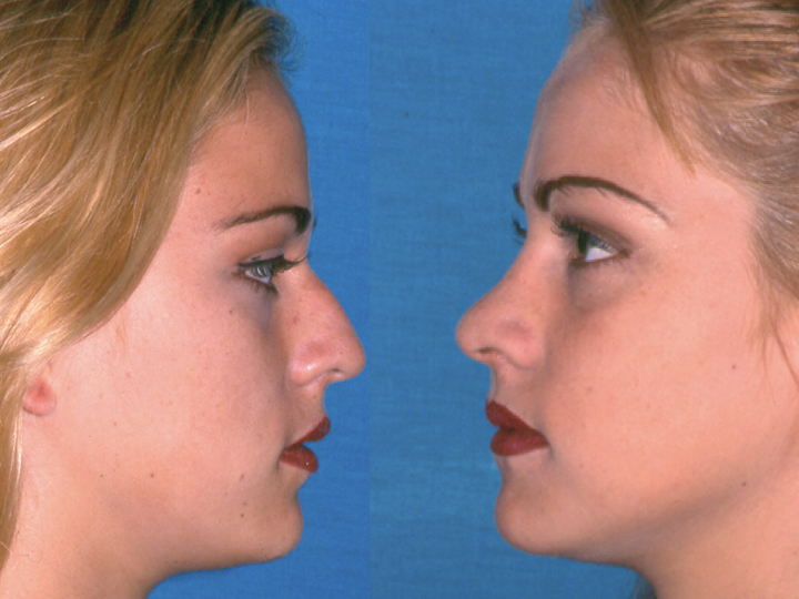 RINOPLASTIA