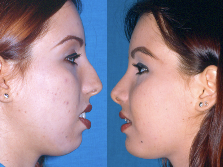 antes y después rinoplastia y cirugía de mentón