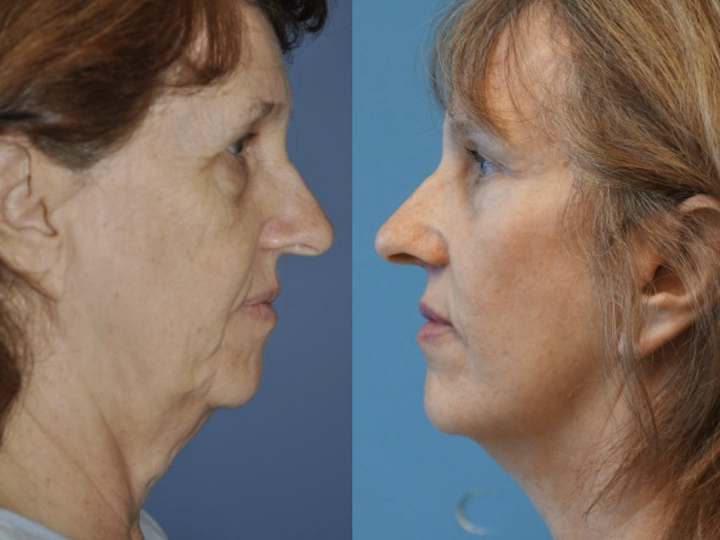 antes y después de rejuvenecimiento facial
