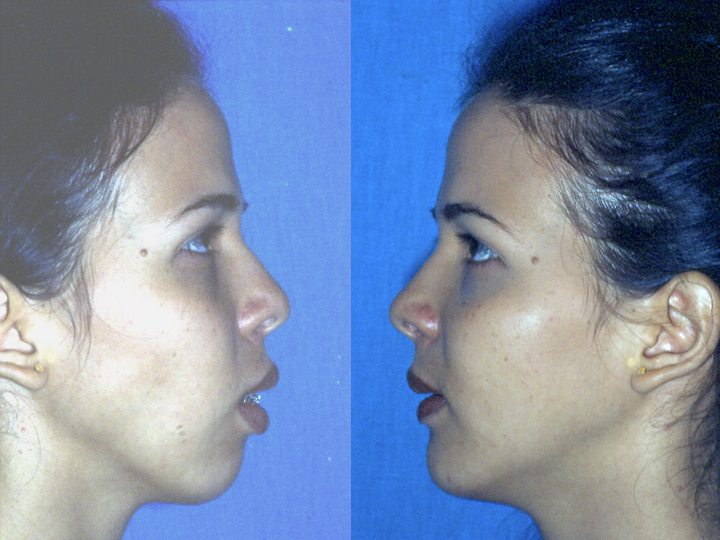 antes y después mentoplastia