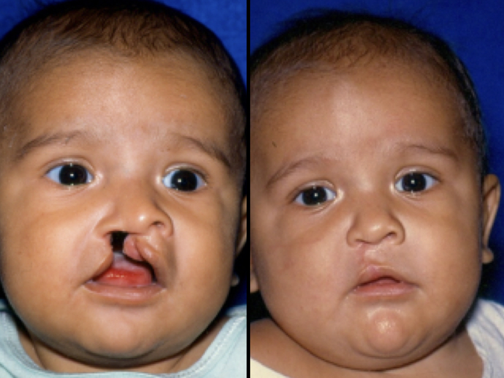 antes y después labio y paladar hendido