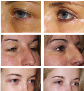 blefaroplastia a&d