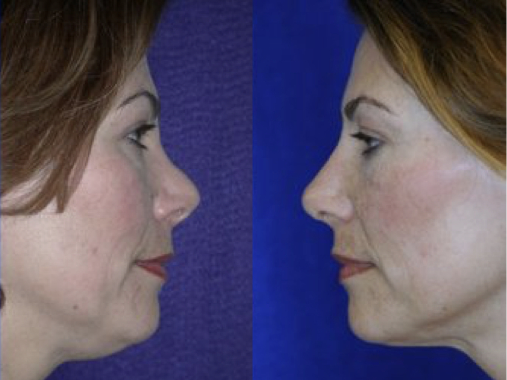 antes y depués de rinoplastia y liposucción de cuello