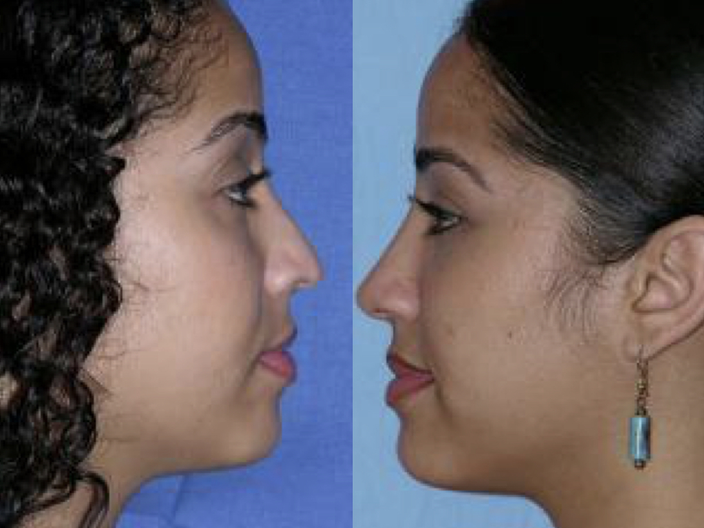antes y después de cirugía de nariz