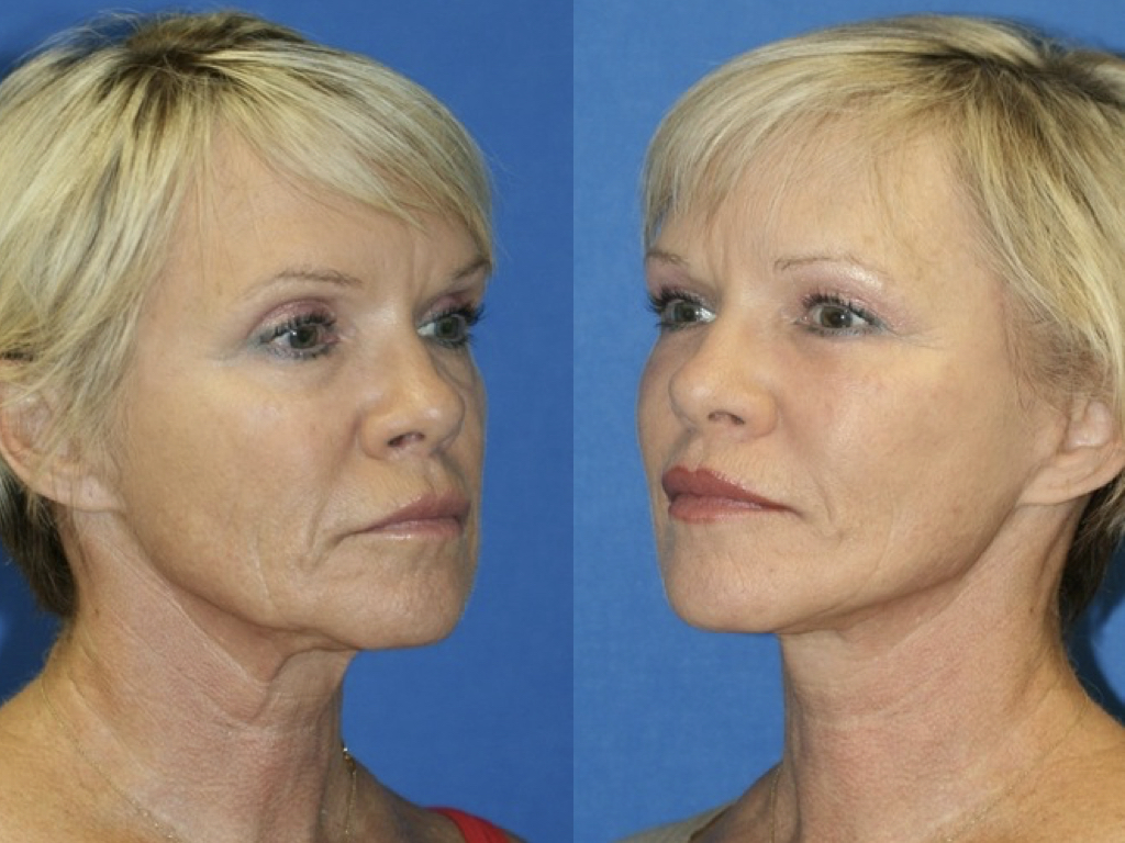 antes y después de lifting facial y peeling