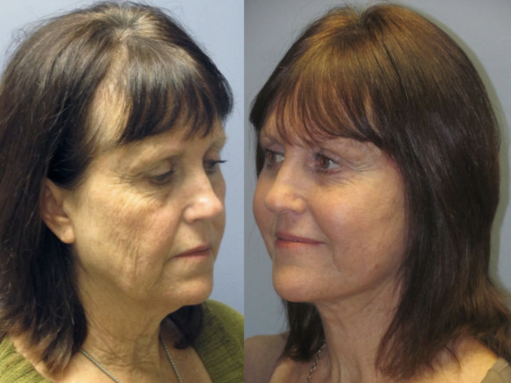 antes y después de peeling químico y lifting facial