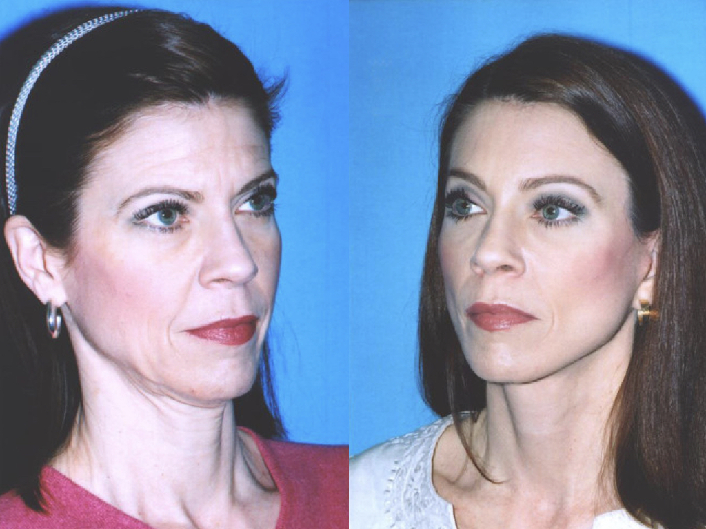antes y después de rejuvenecimiento facial con lifting y blefaroplastia