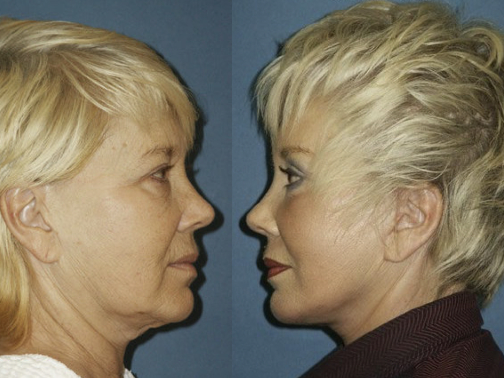 antes y despuées de lifting, peeling y blefaroplastia