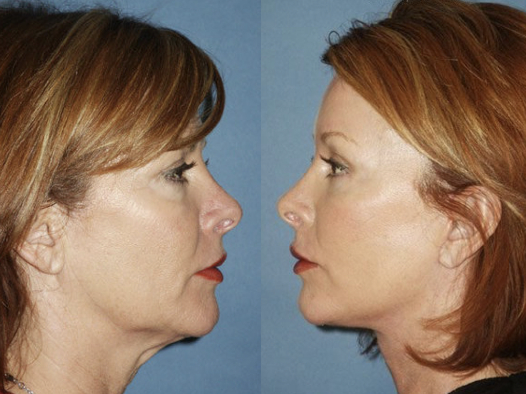 antes y despues lifting, blefaroplastia y peeling