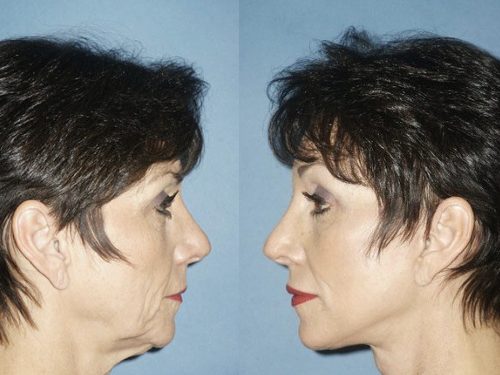 resultados lifting facial, blefaroplastia y peeling