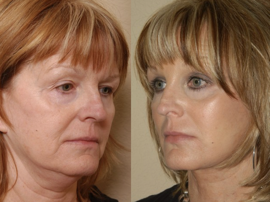 antes y despues de blefaroplastia y lifting facial