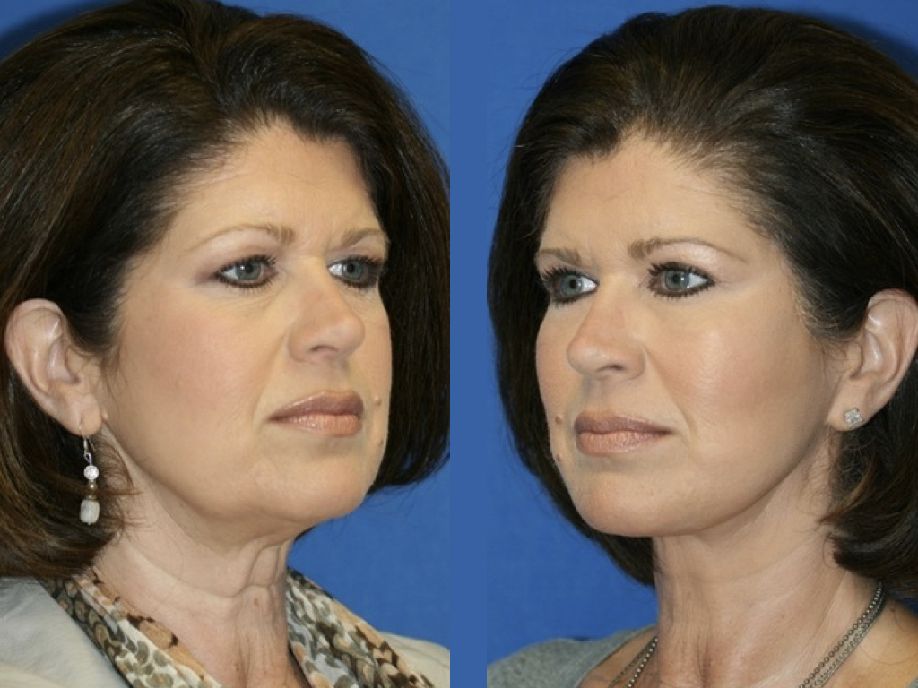 antes y después blefaroplastia y lifting