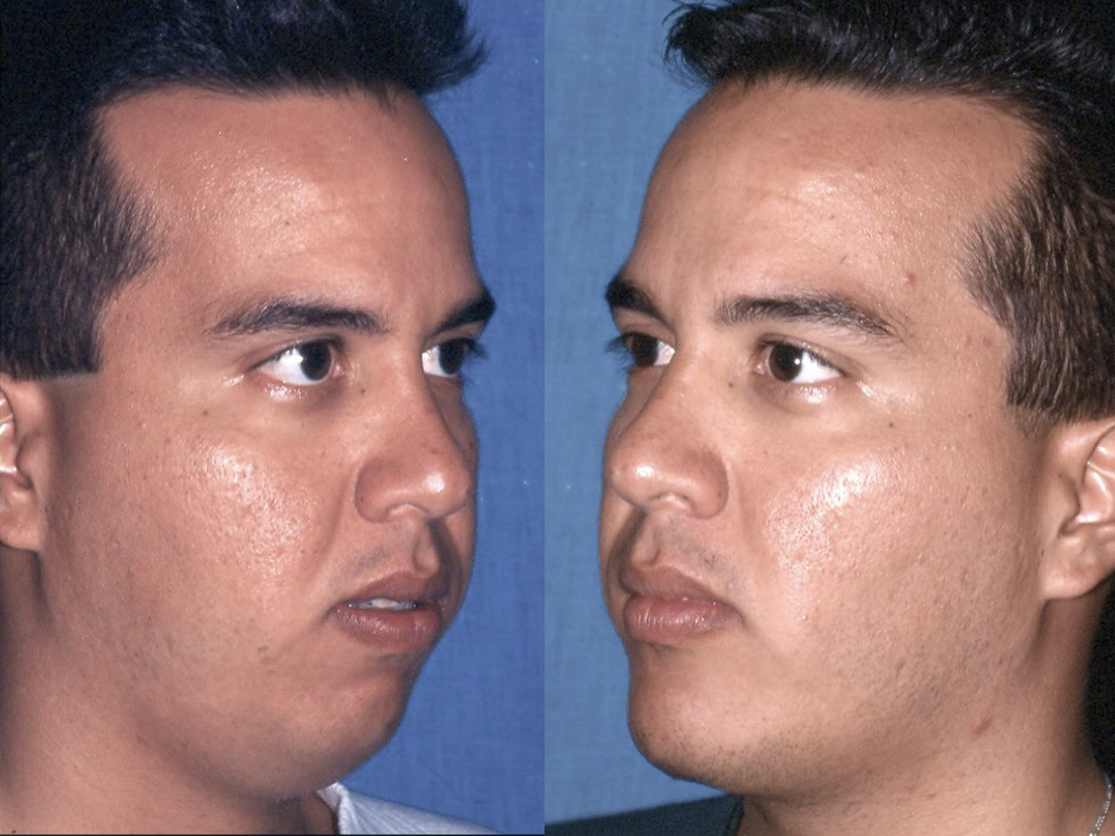 antes y después cirugía de mentón, eliminación papada y liposucción facial