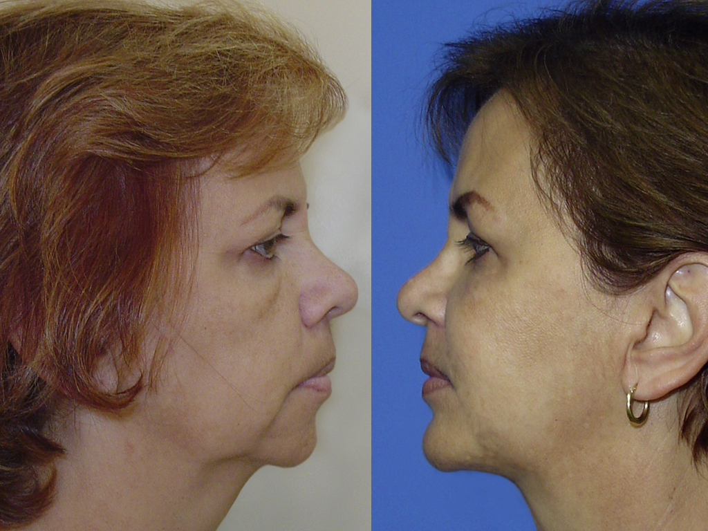 resultado rejuvenecimiento facial completo