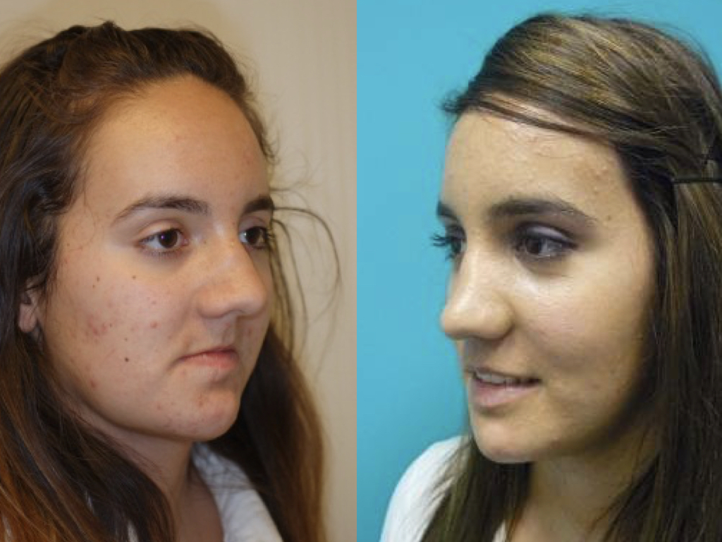 antes y después de cirugía de reconstrucción facial