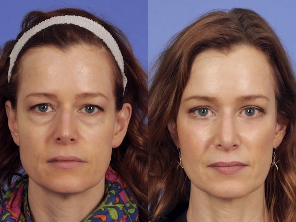 blefaroplastia completo antes y después