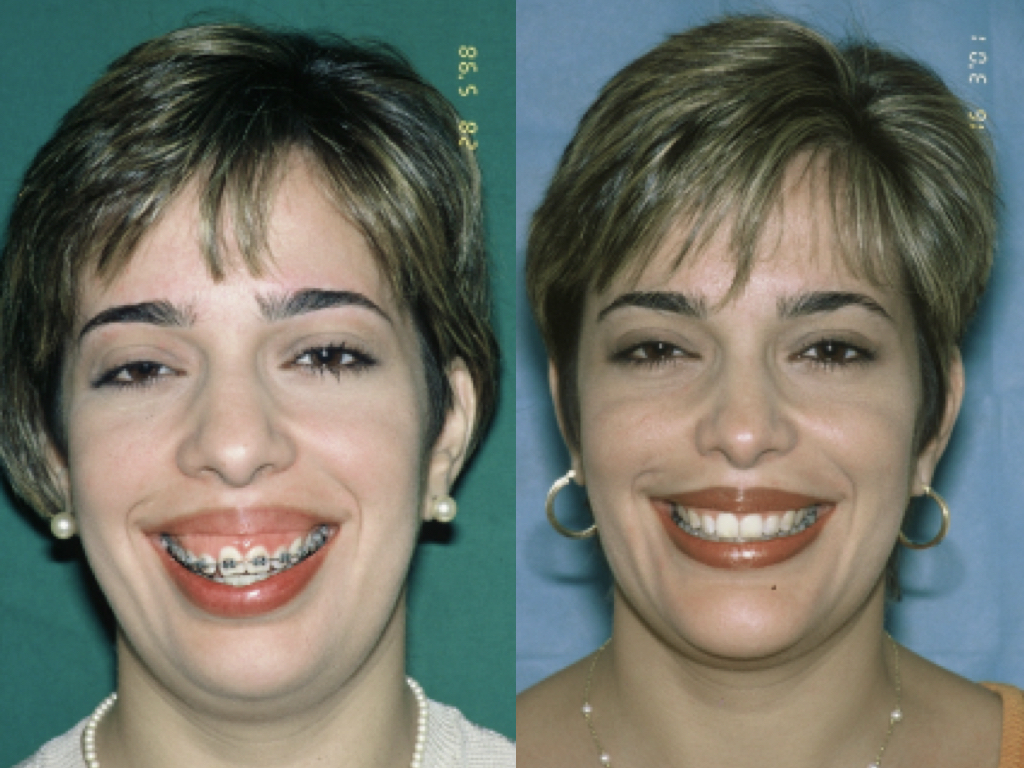 antes y después liposucción y modelado adiposo facial