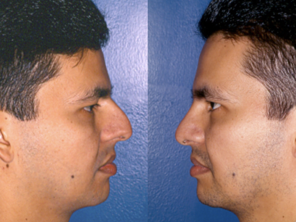 antes y después rinoplastia