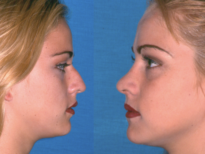 antes y después de rinoplastia