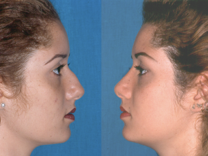 rinoplastia antes y después femenino