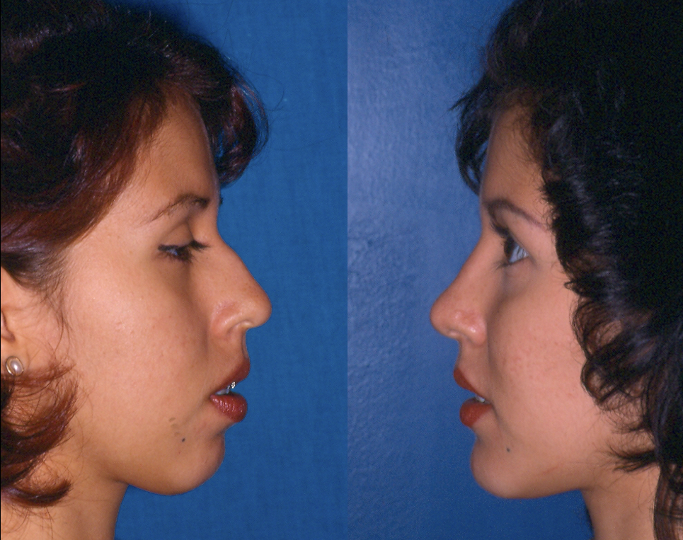 rinoplastia y cirugía de mentón antes y después