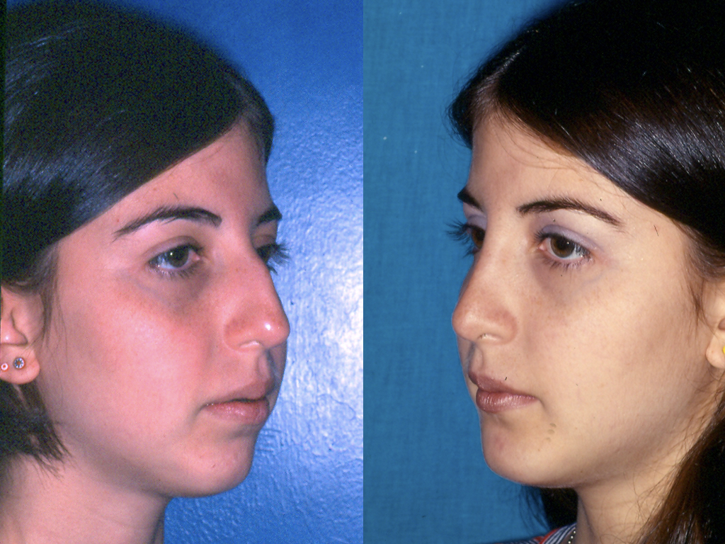 cirugía de nariz antes y depués
