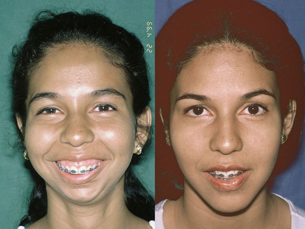 cirugía ortognática antes y depués femenino