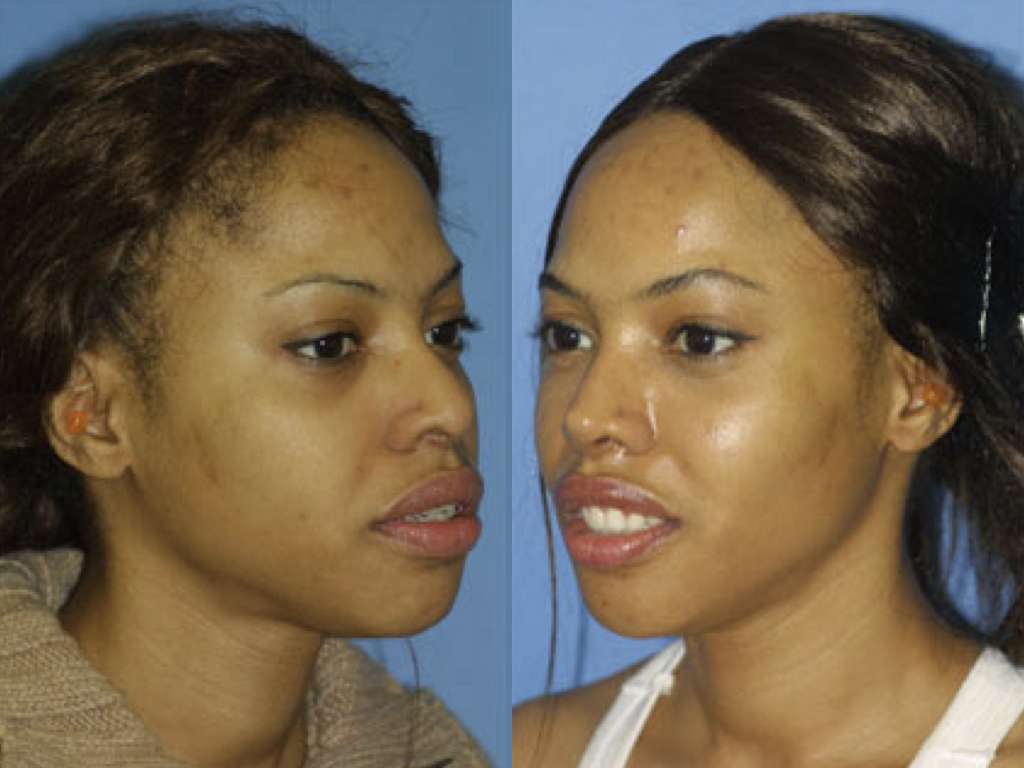 antes y después cirugía facial