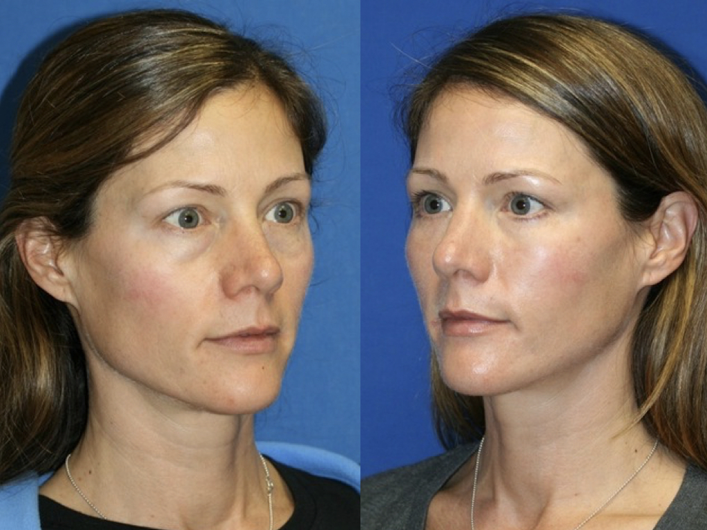 rejuvenecimiento facial resultados