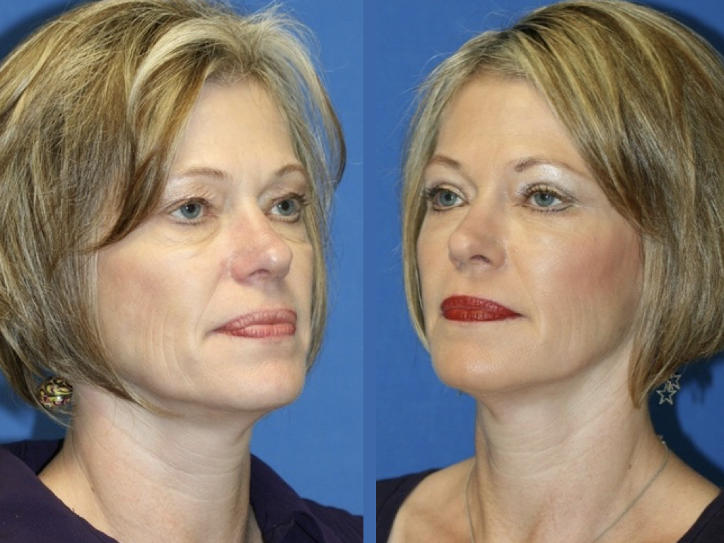 rejuvenecimiento facial, antes y después