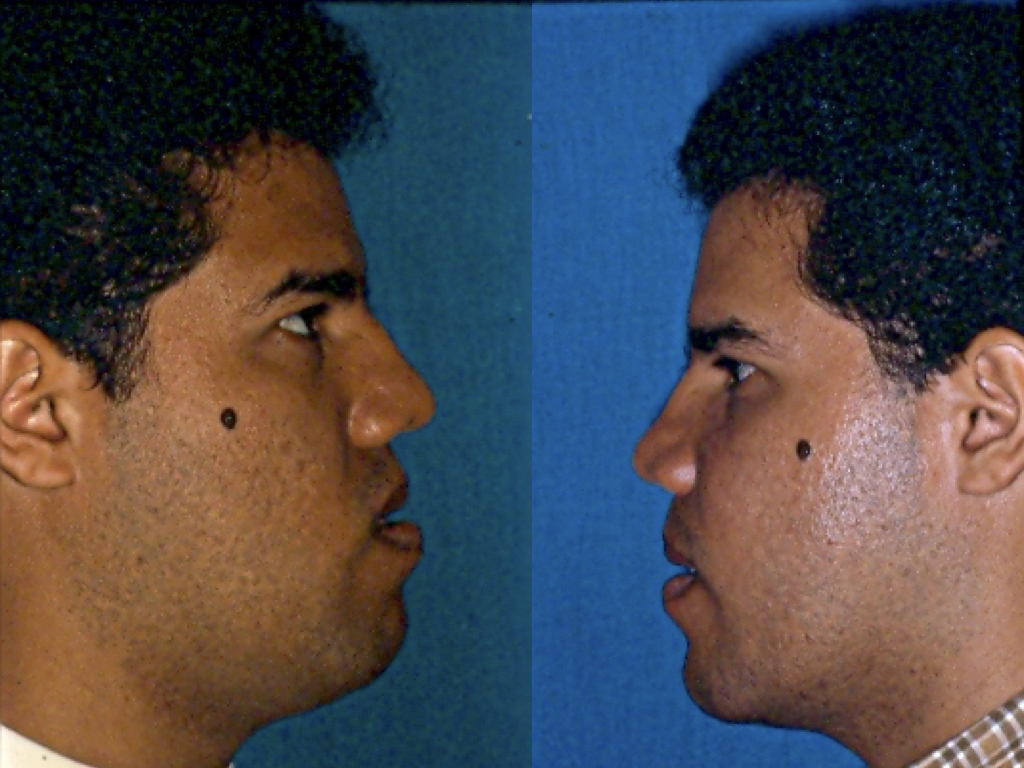 antes y después cirugía de mentón