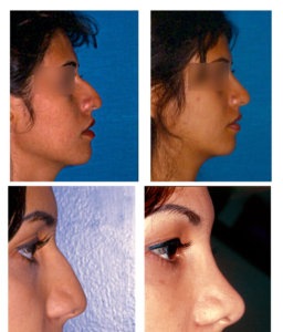 rinoplastia2