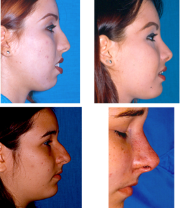 rinoplastia3