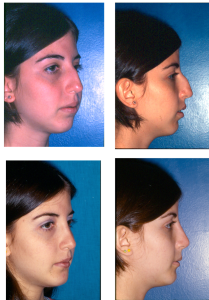 rinoplastia4