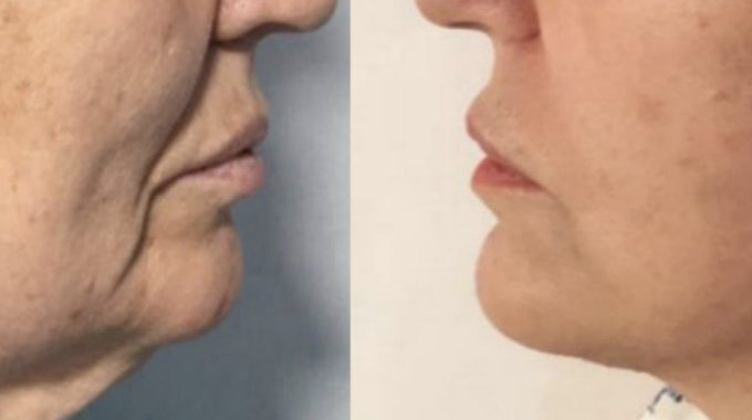 Antes Y Después Rejuvenecimiento Facial